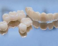 Why Should You Choose Ceramic Crown??